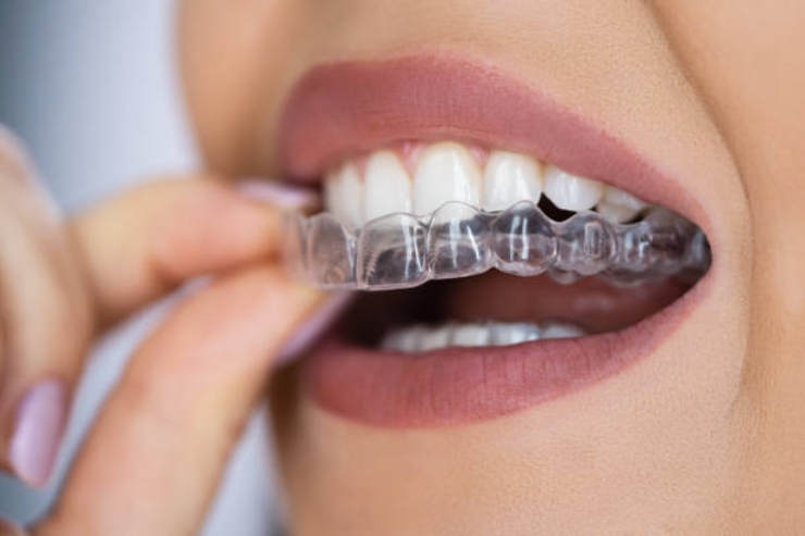 Aligners ------22