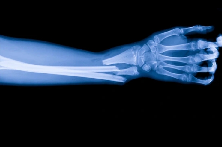 Bone Injuries-------20