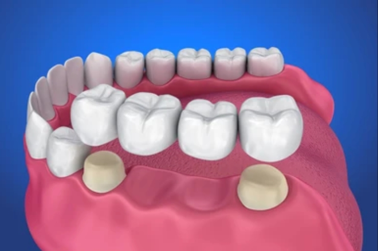 Dental Bridges--------20