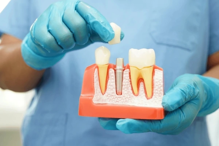 Dental Crowns--------20