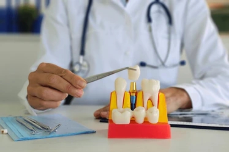 Dental Implants