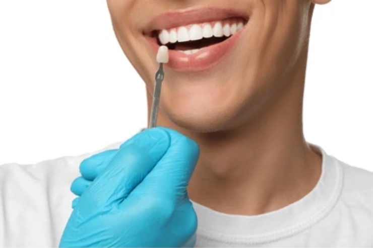 Dental Veneers-------20
