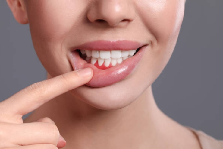 Gum Disease Treatment-